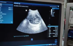 Monitor mostra os resultados de um exame de ultrassom