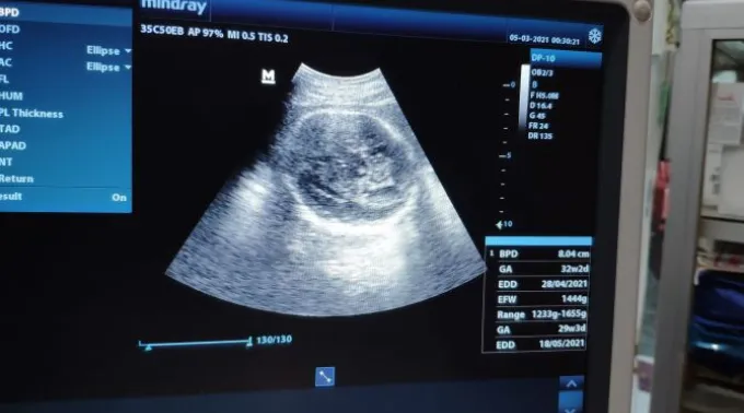 Monitor mostra os resultados de um exame de ultrassom