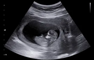 Ultrassom às 12 semanas de gestação