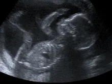 Um bebê com 20 semanas — no segundo trimestre, quando abortos por dilatação e curetagem são comumente feitos.