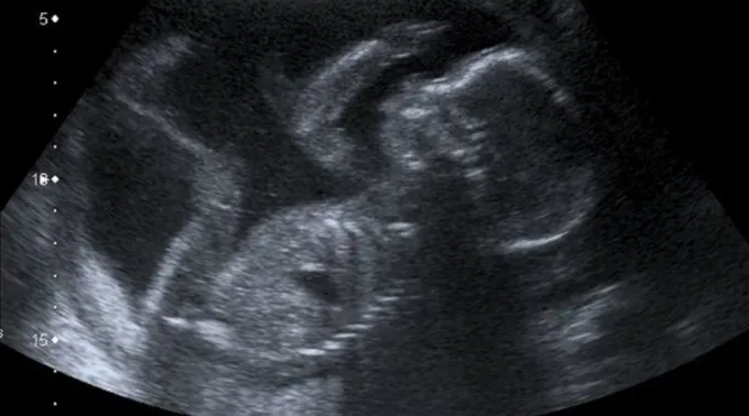 Um bebê com 20 semanas ?? 