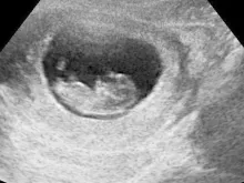 Uma ultrassonografia. Foto Wikipédia (Domínio público)