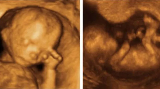 Ecografia12semanas-Wikipedia-11072019.jpg ?? 