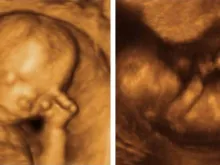 Ultrassonografia de nascituro de 12 semanas. Crédito: Wikipédia (CC BY-SA 3.0)