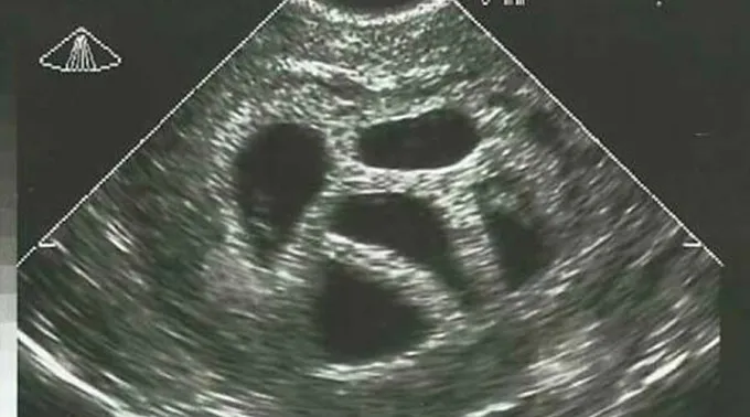 EcografiaQuintillizos_FacebookSusanThompson_281016.jpg ?? 