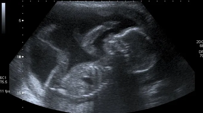 Ecografia_FlickrSteveCC-BY-NC-2.0_310117.jpg ?? 