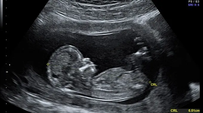 Ecografia_WikipediaWolfgangMoroder_CC-BY-SA-3.0.jpg ?? 