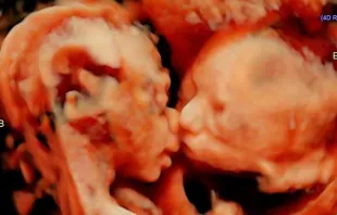 As gêmeas Isabella e Callie partilhando um gesto de carinho dentro do ventre 