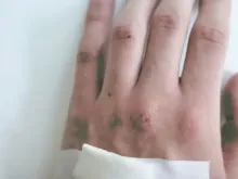 Mão com sinais de varíola
