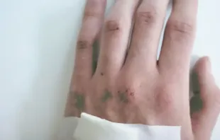 Mão com sinais de varíola